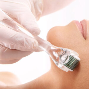 Microneedling Treatment | Carbon Blush