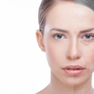 Woman Before and After Skin Peel | Carbon Blush